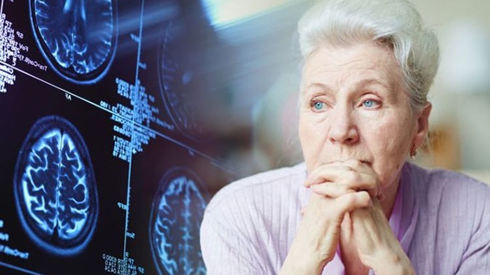 Người bệnh Alzheimer cần được phát hiện sớm và điều trị kịp thời để ngăn ngừa bệnh tiến triển nặng hơn
